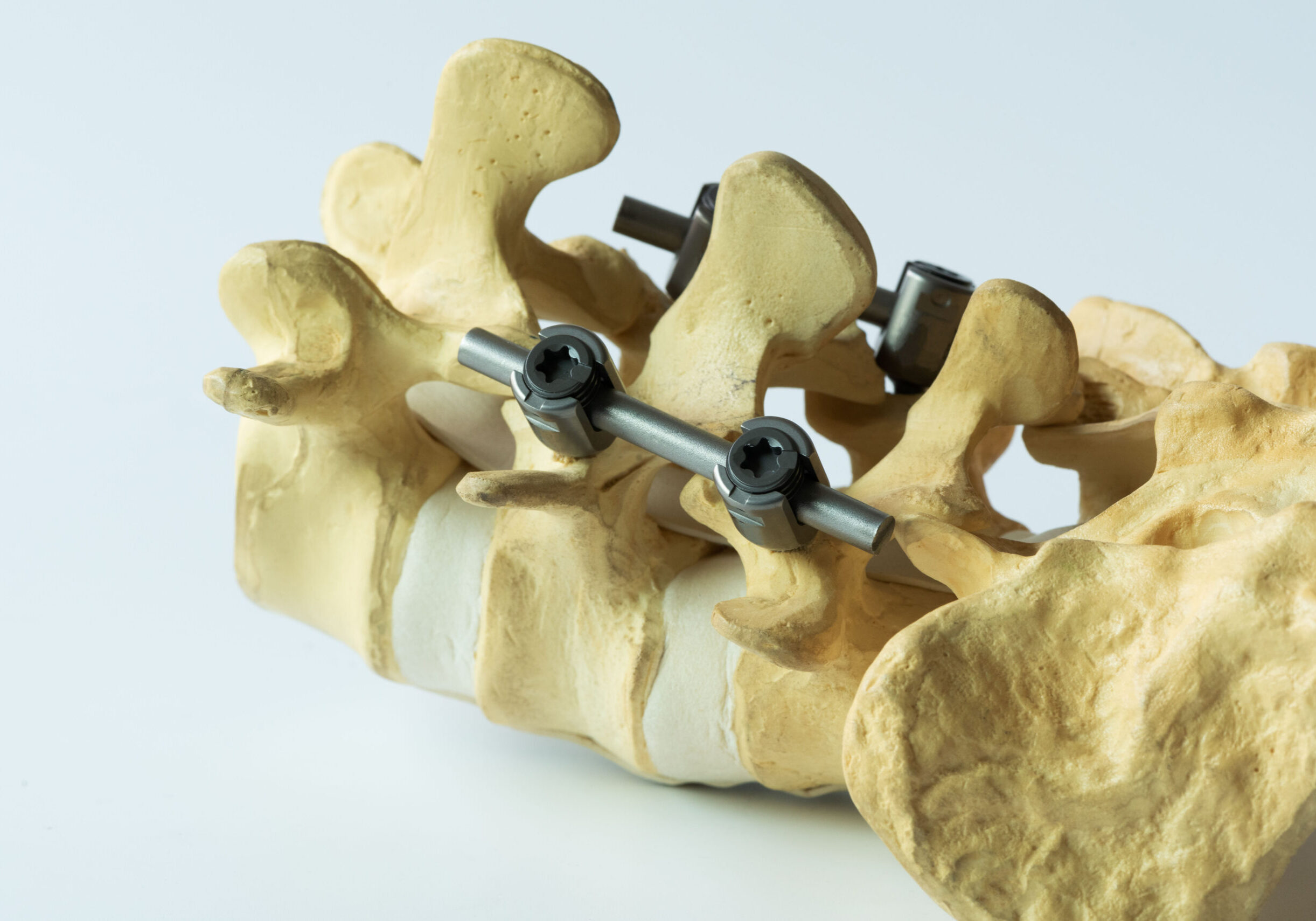 Close-up view instrument fixation of lumbar spine model on white background.